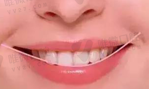 戴牙套和活动假牙的区别,戴假牙可以戴牙套吗(图1)